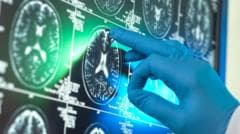 Breakthrough £90,000 Alzheimer's drugs unlikely to benefit patients, report suggests