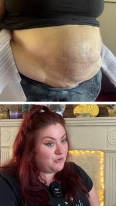 'Why I'm showing my hernia online'