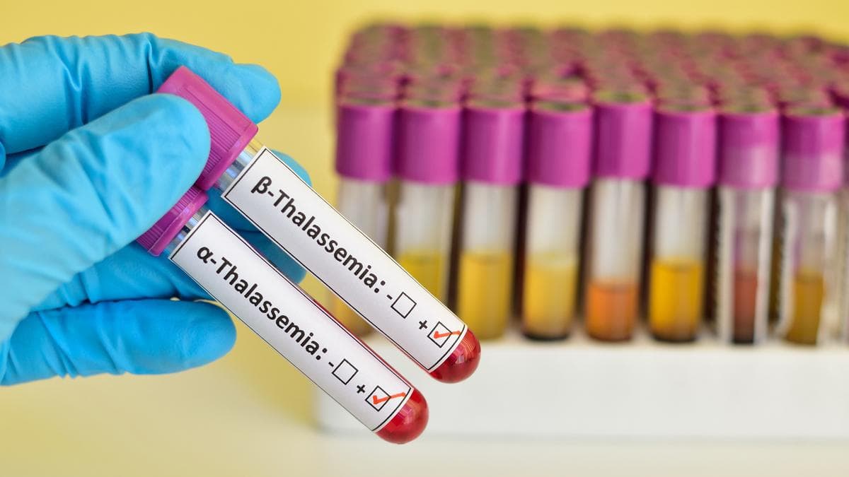 Four more kids suffering from thalassemia test HIV-positive in Chaibasa; probe underway
